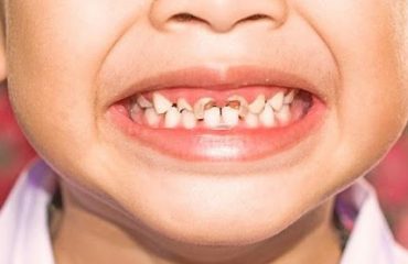 unnamed (1) دندان شیری